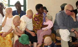 Tính mạng những người bạch tạng luôn bị đe dọa tại nhiều quốc gia châu Phi.