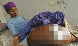 Gurmeet Singh mang trên người khối u khổng lồ suốt nhiều năm. Ảnh: Dailymail