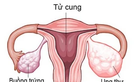 Bạn biết gì về ung thư buồng trứng?