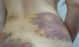 Vết thương trên cơ thể chị Sang