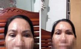 Sau hai lần phẫu thuật, đôi mắt của ba L. không như kỳ vọng