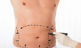 Phẫu thuật tạo hình nhằm cải thiện cơ thể hiện đang trở thành xu hướng mới tại Mỹ