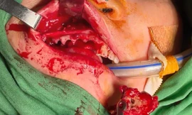 Bác sĩ nhổ hết răng loại bỏ xương chết cho bệnh nhân