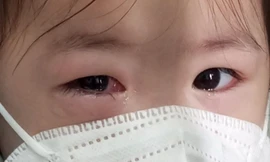Hơn 2.300 học sinh một huyện phải nghỉ học vì đau mắt đỏ, cần làm gì để phòng tránh?