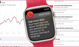 Apple Watch phát hiện được các triệu chứng về tuyến giáp vài tháng trước khi chẩn đoán?