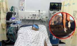 Nam sinh ngất xỉu vì sốc nhiệt, tổn thương gan và thận sau khi chạy thể dục dưới trời nóng