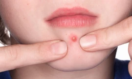 Nữ sinh 15 tuổi ở Hà Nội tử vong sau khi nặn mụn, bôi thuốc không rõ nguồn gốc