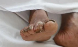 Nam sinh lớp 10 qua đời do nhiễm vi khuẩn ăn thịt người, cần làm gì để phòng bệnh Whitmore?