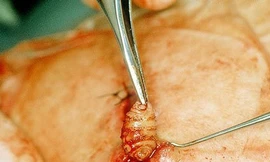 Phát hiện giòi ăn thịt sống dưới da người