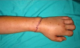 Nối thành công cẳng tay bị chém đứt lìa