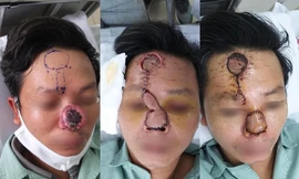 Kỳ diệu tái tạo mũi cho bệnh nhân ung thư bị xâm lấn đường thở
