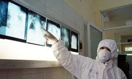 Bệnh nhân 416 tiên lượng nặng hơn nam phi công người Anh