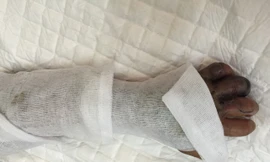 Bị rắn cắn, bé 10 tuổi hoại tử nặng vì đắp lá thuốc