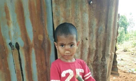 Kỳ lạ trẻ có não thoát xuống mũi