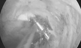 Không theo chỉ định bác sĩ, bệnh nhân bị đinh xuyên phổi vào tủy sống