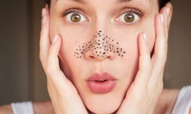 Thổi bay mụn đầu đen bằng những phương pháp gần như chẳng tốn xu nào