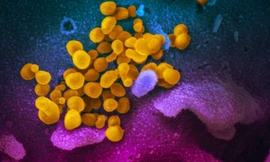 Ảnh chụp dưới kính hiển vi nhóm virus SARS-CoV-2 (màu vàng) trong một bệnh nhân người Mỹ