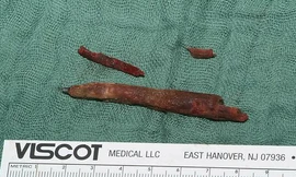 Chiếc bút chì được lấy ra khỏi đầu bệnh nhân