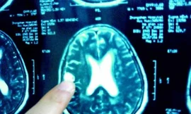 Ăn đồ tái, sán ‘dạo chơi’ trong não