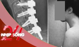 NHỊP SỐNG 24: Thanh niên mắc ‘hội chứng rụng đầu' vì dùng điện thoại
