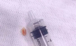 Hạt lạc mắc kẹt gần một tháng trong khí quản cháu bé 18 tháng tuổi