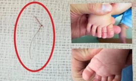 Sợi tóc thắt vào chân, bé gái 4 tháng tuổi suýt mất ngón