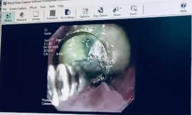 Sản phụ suýt mất mạng vì nuốt túi mật lợn