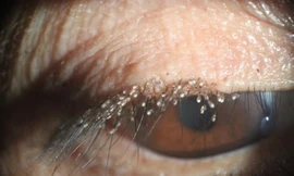 Rận ký sinh và đẻ trứng chi chít trên mi mắt người phụ nữ