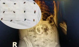 Nuốt 25 viên bi nam châm vào bụng, bé 3 tuổi bị thủng ruột, tá tràng