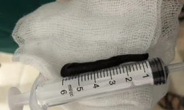 Gắp đỉa sống dài 6cm từ khí quản người đàn ông