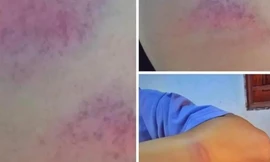 Thầy giáo cấp 2 ở Nghệ An bị tố đánh nữ sinh bầm tím tay