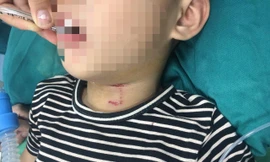 Bé 3 tuổi bị chó cắn rách vùng cổ, thủng khí quản