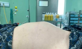 Thiếu nữ 18 tuổi bụng to như mang thai 7 tháng, không ngờ u buồng trứng ‘khủng’