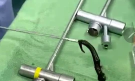 Kinh hãi vắt rừng căng máu ký sinh trong đường thở bé 6 tuổi