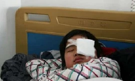 Em Dou sau khi phẫu thuật mắt vì giáo viên sai bạn tát 40 cái vào mặt