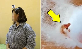 Cô gái Sơn La nặn mụn ở ngực ra nguyên con sán lá gan ngoe nguẩy