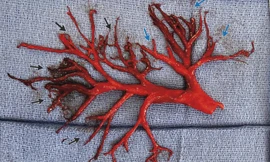 Sự thật bệnh nhân đang điều trị tim thì ho ra cả phổi