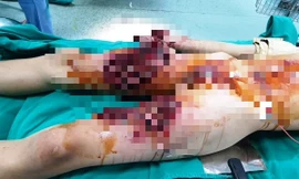 Học sinh bị nát bàn tay do làm pháo