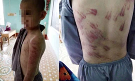 Lãnh đạo huyện Hà Trung lên tiếng vụ học sinh tiểu học bị đánh bầm tím