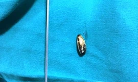 Bé trai 17 tháng tuổi hóc hạt hướng dương ở đường thở