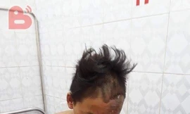 Thiếu niên 15 tuổi bị sét đánh cháy xém nửa người