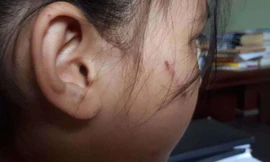 Công an vào cuộc vụ bé lớp 2 bị bố đánh thâm tím
