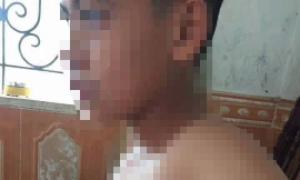 Phụ huynh xông vào trường đánh học sinh lớp 7 bầm tím sườn