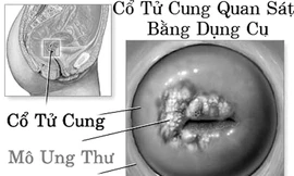 Tiêu diệt tế bào ung thư bằng cách “bỏ đói”