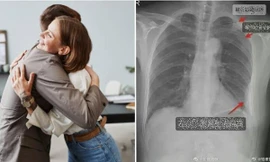 Bị đồng nghiệp ôm chào hỏi mạnh đến mức gãy luôn 3 xương sườn, cô gái Trung Quốc khởi kiện