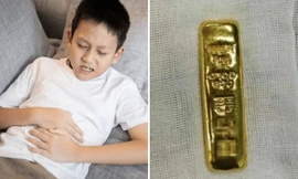 Bé trai ở Trung Quốc thấy bụng bị sưng, hóa ra bé đã nuốt một thỏi vàng lớn