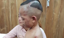 Bị cha dượng đánh dã man vì quấy khóc, bé 3 tuổi thương tật 24%