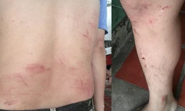 Nhiều vết thương trên người anh Quý