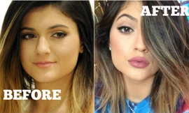 Tại sao mọi người đều tiêm filler làm đầy môi? Những khao khát dấu đằng sau mốt môi dày