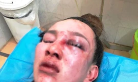 Chị V đang điều trị tại bệnh viện